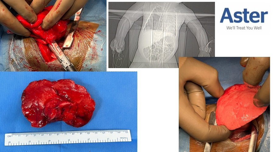 Breakthrough Surgery: 27-Day-Old Infant Cured of Rare Lung issue