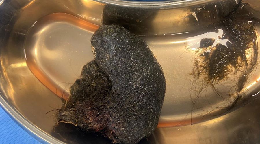 A Hair-Raising Tale: Doctors Remove Massive Hairball from Child’s Stomach, Saving Life