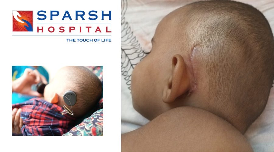 A One-Year-Old Received a New Lease of Life with a Cochlear Implant
