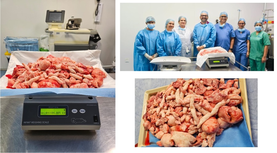 One of the Largest Fibroid uterus removed through Laparoscopic Surgery at ASTER RV Hospital – First of its kind in South India, weighing 4.005 KGS!