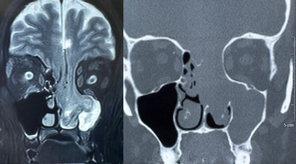 When the Brain peeked through the Nose! Doctors at Manipal Hospitals Dwarka save a 33-year-old from a fatal condition